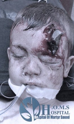 O μικρός Fadi  θύμα των ρωσικών βομβαρδισμών στη Συρία